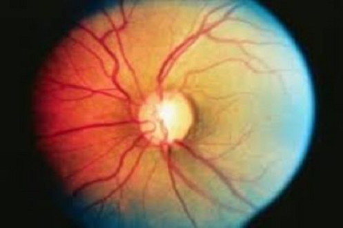 काचबिंदू म्हणजे काय? (Glaucoma Week Special)